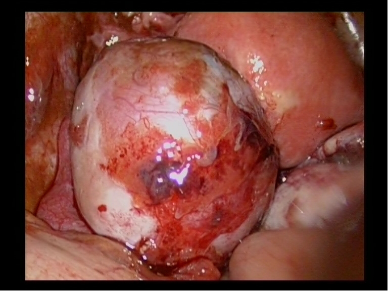 Endometriotic Ovarian Choclate Cyst Endometriotic Ovarian Choclate Cyst